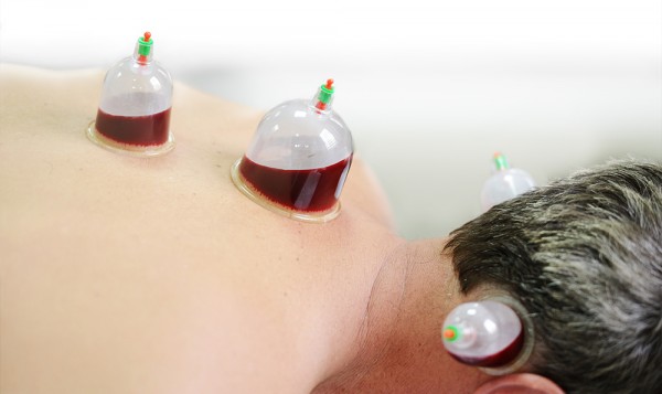 Wet cupping has one extra step in which an incision is made, and a small quantity of blood is drawn from the suctioned area. It’s mostly recommended for men and postmenopausal women.